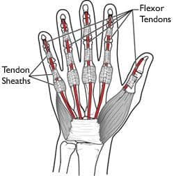 Causes of Flexor Tendon Tears