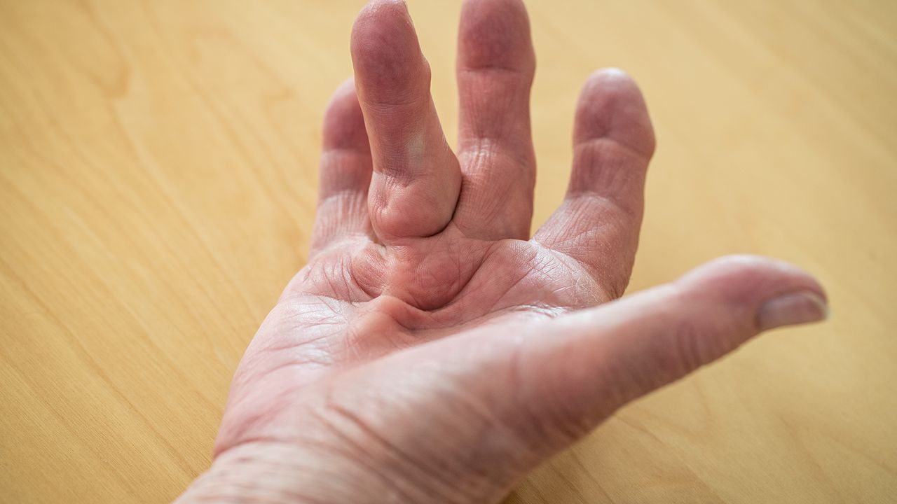 Dupuytren’s Contracture cityothosports