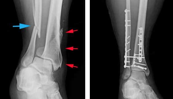 Nonunion Fracture