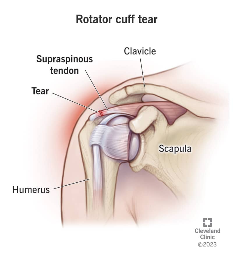 Rotator Cuff Tears