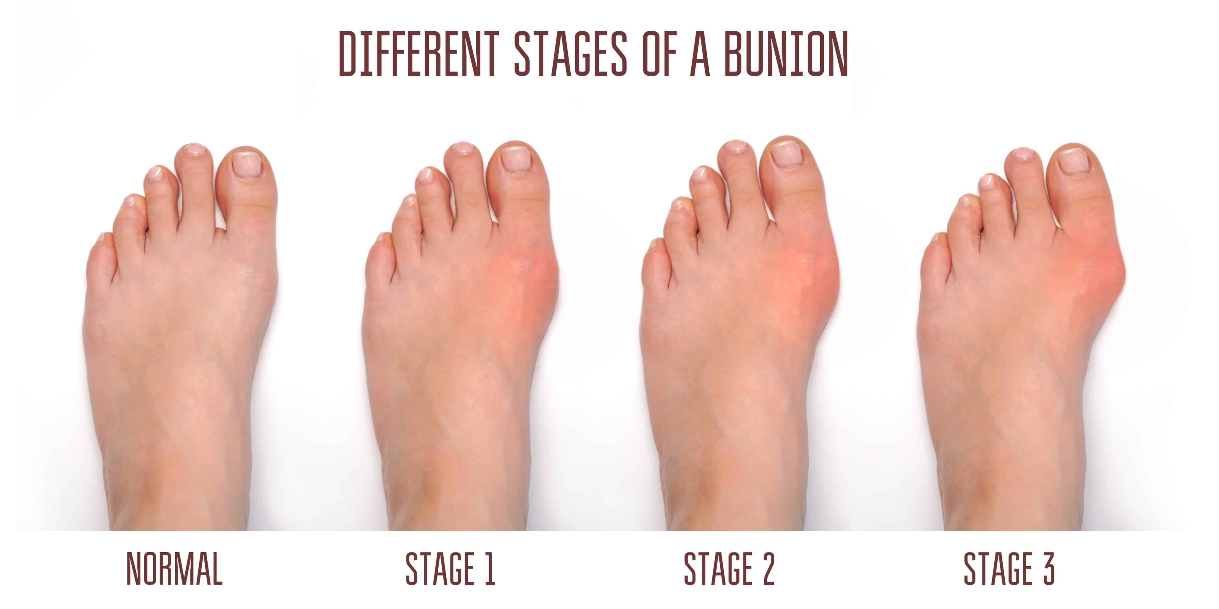 Different stages of Bunions 
