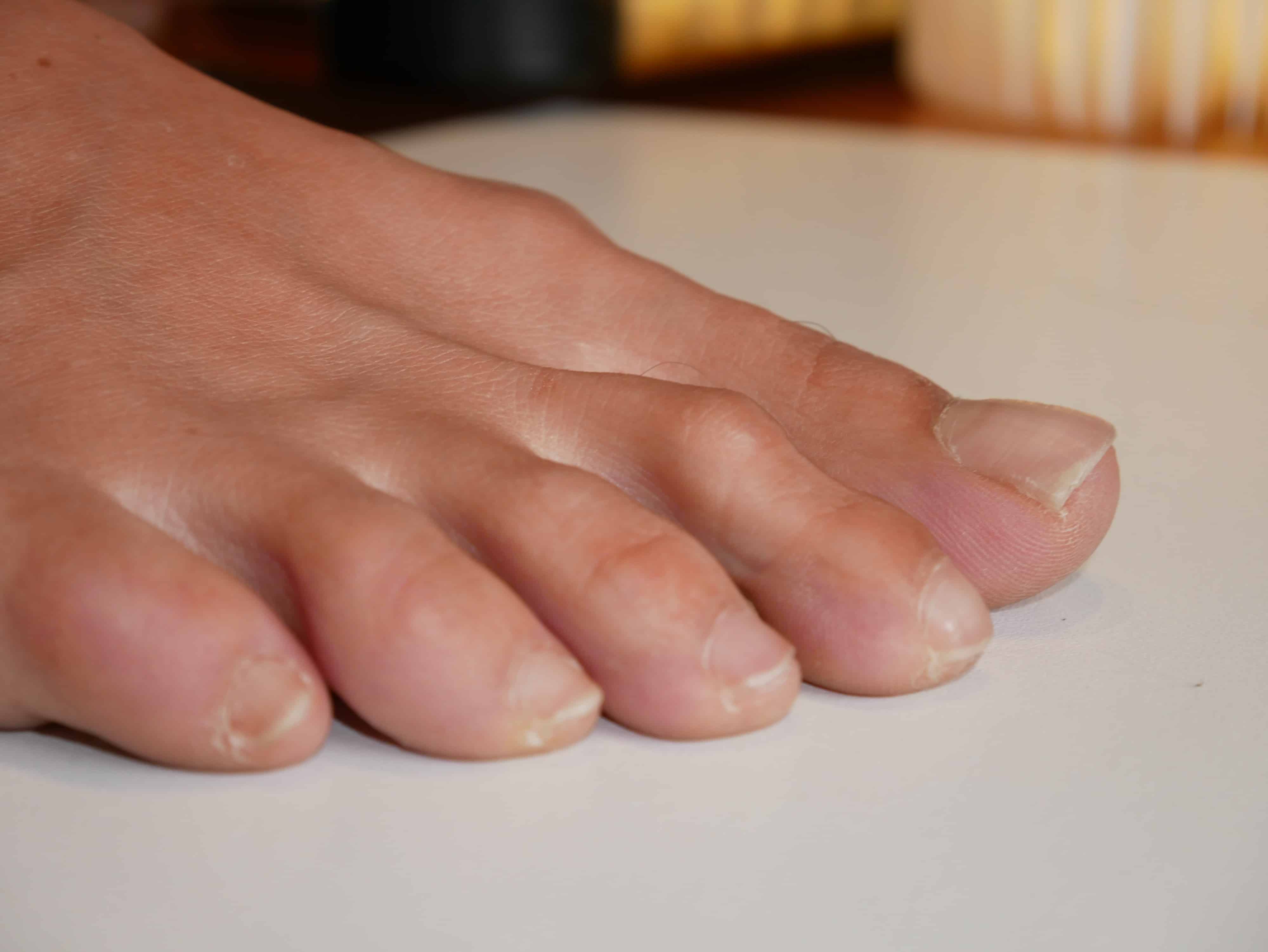 Hammertoe image
