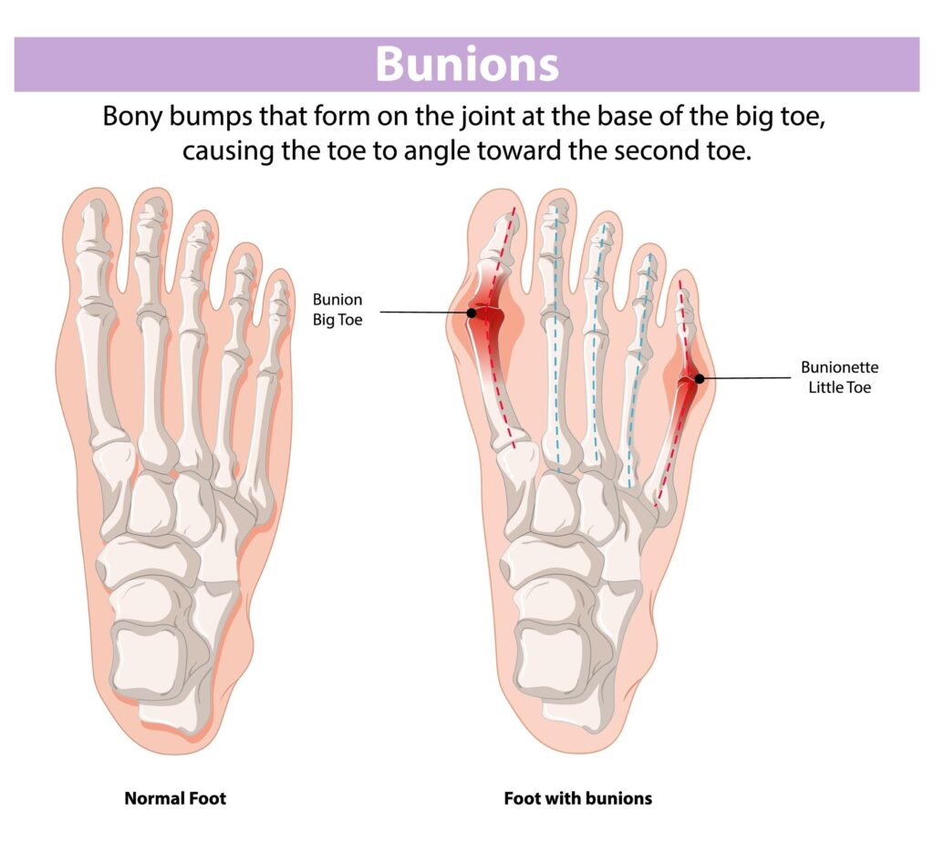 Image of bunion foot deformity anatomy